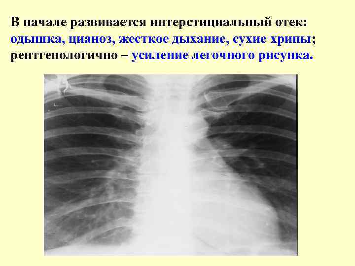 В начале развивается интерстициальный отек: одышка, цианоз, жесткое дыхание, сухие хрипы; рентгенологично – усиление