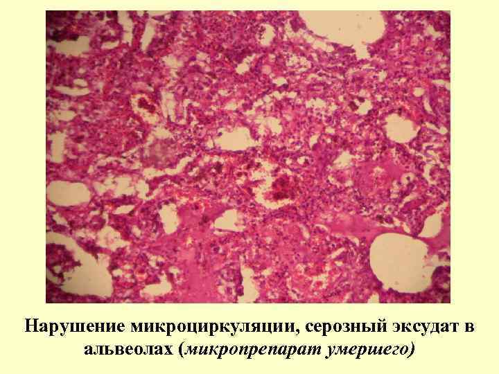 Нарушение микроциркуляции, серозный эксудат в альвеолах (микропрепарат умершего) 