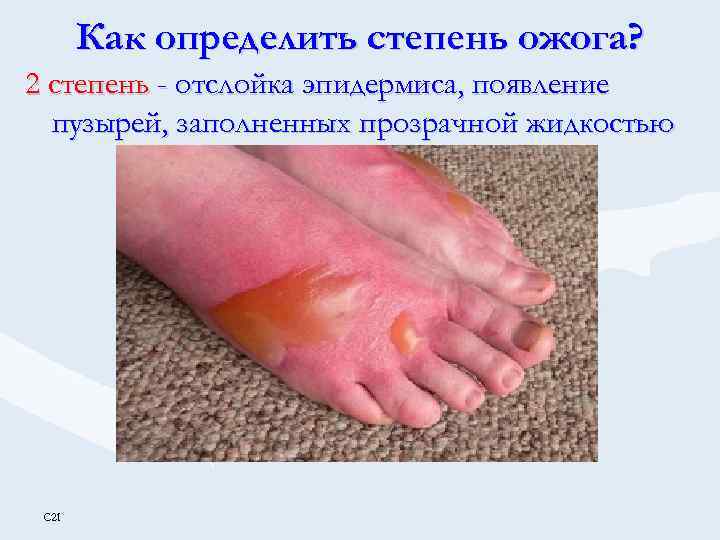 Как определить степень ожога? 2 степень - отслойка эпидермиса, появление пузырей, заполненных прозрачной жидкостью