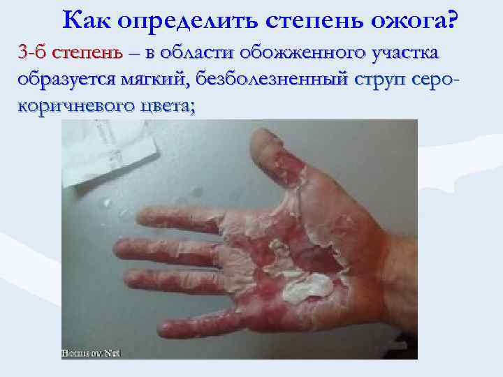 Как определить степень ожога? 3 -б степень – в области обожженного участка образуется мягкий,