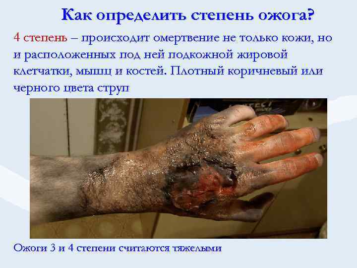 Как определить степень ожога? 4 степень – происходит омертвение не только кожи, но и