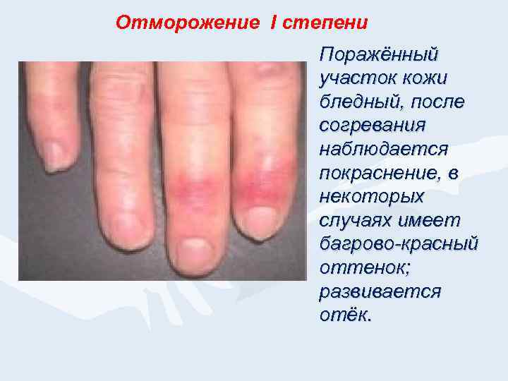 Отморожение I степени Поражённый участок кожи бледный, после согревания наблюдается покраснение, в некоторых случаях