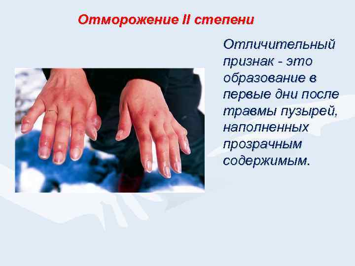 Отморожение II степени Отличительный признак - это образование в первые дни после травмы пузырей,