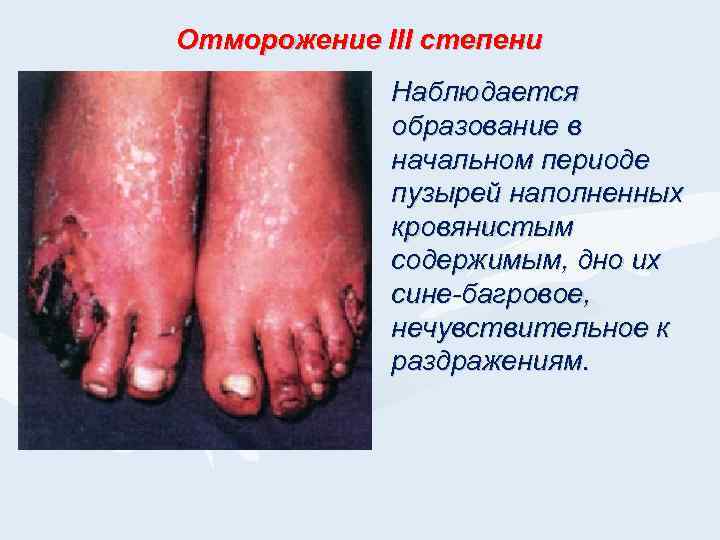 Отморожение III степени Наблюдается образование в начальном периоде пузырей наполненных кровянистым содержимым, дно их