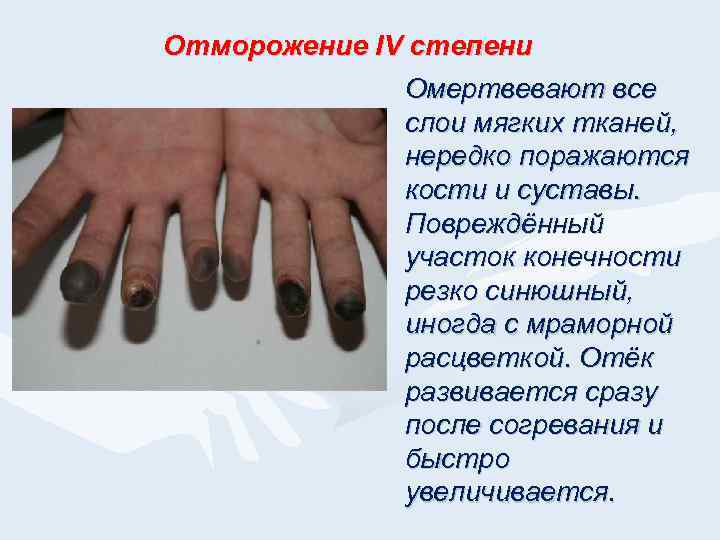 Отморожение IV степени Омертвевают все слои мягких тканей, нередко поражаются кости и суставы. Повреждённый