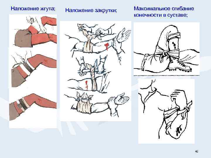 Наложение жгута; Наложение закрутки; закрутки Максимальное сгибание конечности в суставе; 46 