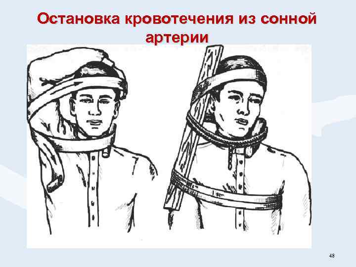 Остановка кровотечения из сонной артерии 48 