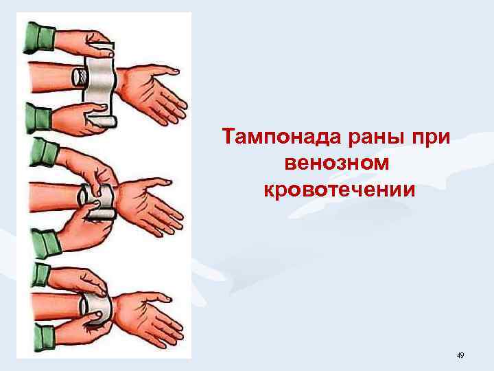 Тампонада раны при венозном кровотечении 49 
