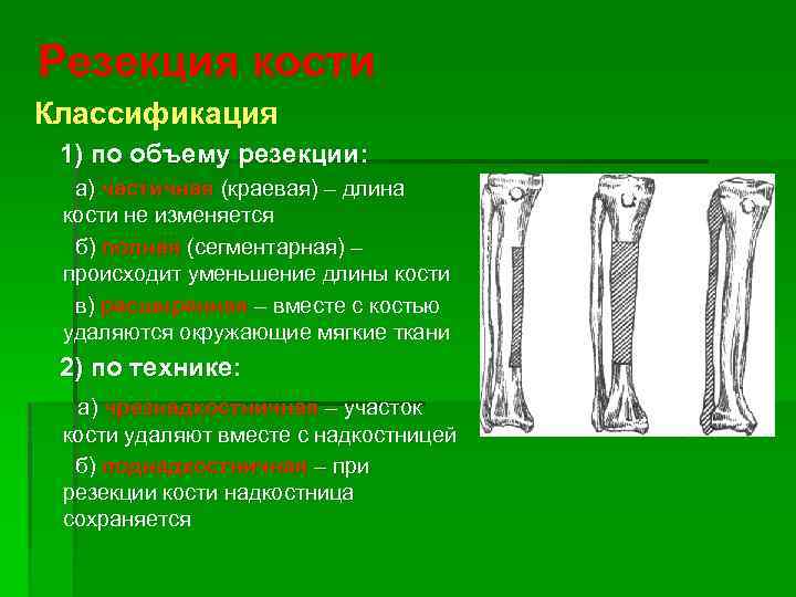 Резекция кости Классификация 1) по объему резекции: а) частичная (краевая) – длина кости не