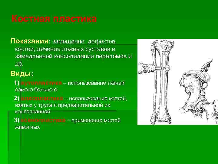 Костная пластика Показания: замещение дефектов костей, лечение ложных суставов и замедленной консолидации переломов и