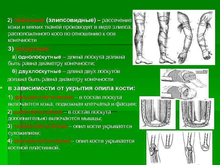 2) овальные (элипсовидные) – рассечение кожи и мягких тканей производят в виде элипса, расположенного