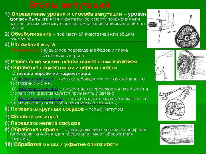 Этапы ампутаций 1) Определение уровня и способа ампутации – уровень должен быть как можно