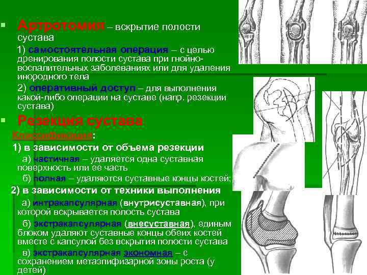 § Артротомия – вскрытие полости сустава 1) самостоятельная операция – с целью дренирования полости