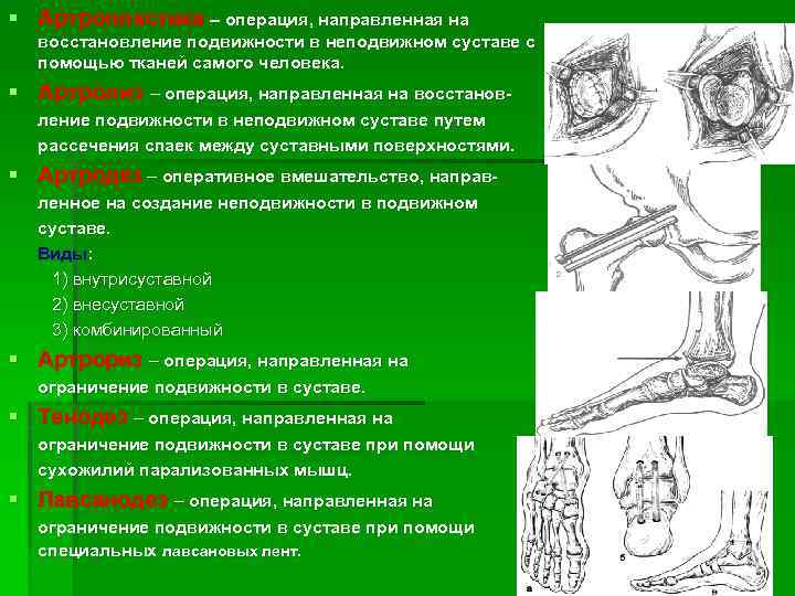 § Артропластика – операция, направленная на восстановление подвижности в неподвижном суставе с помощью тканей