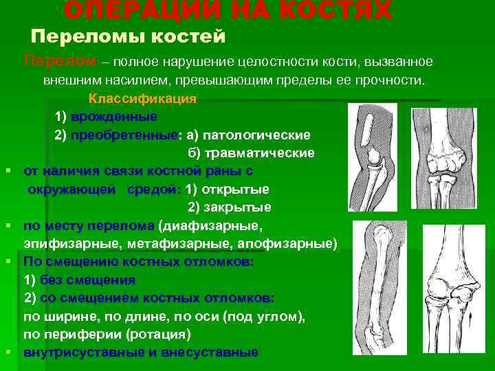 ОПЕРАЦИИ НА КОСТЯХ Переломы костей Перелом – полное нарушение целостности кости, вызванное § §