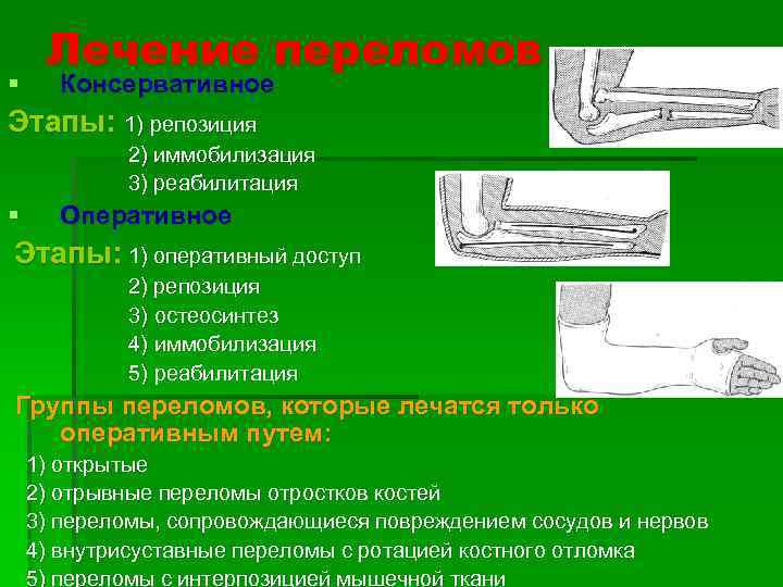 § Лечение переломов Консервативное Этапы: 1) репозиция 2) иммобилизация 3) реабилитация § Оперативное Этапы: