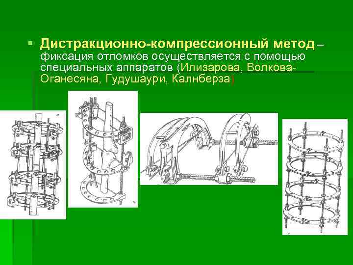 § Дистракционно-компрессионный метод – фиксация отломков осуществляется с помощью специальных аппаратов (Илизарова, Волкова. Оганесяна,