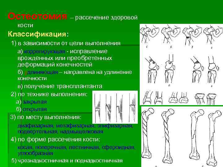 Остеотомия – рассечение здоровой кости Классификация: 1) в зависимости от цели выполнения а) коррегирующая