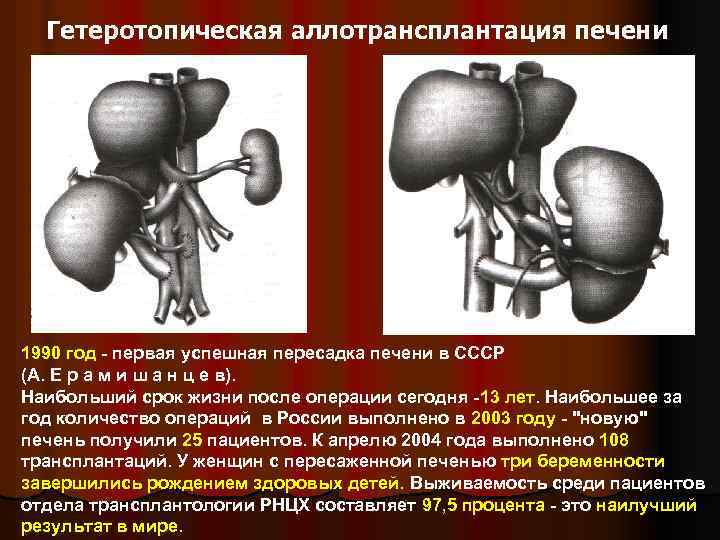 Гетеротопическая аллотрансплантация печени 1990 год - первая успешная пересадка печени в СССР (А. Е