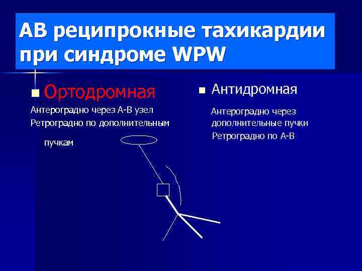 АВ реципрокные тахикардии при синдроме WPW n Ортодромная Антероградно через А-В узел Ретроградно по