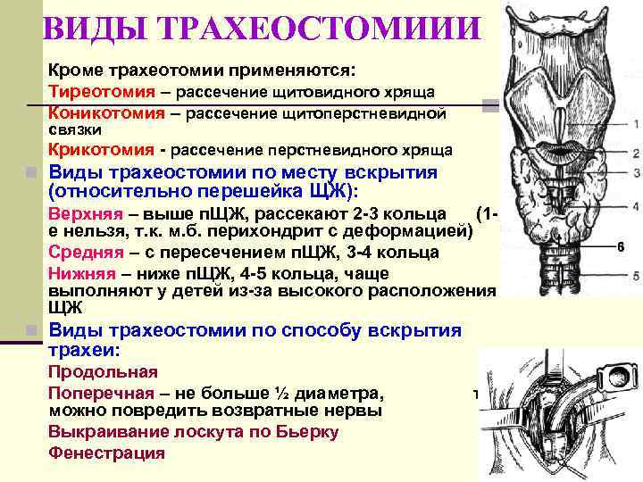 ВИДЫ ТРАХЕОСТОМИИИ Кроме трахеотомии применяются: Тиреотомия – рассечение щитовидного хряща Коникотомия – рассечение щитоперстневидной