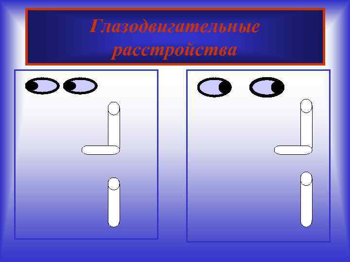 Глазодвигательные расстройства 