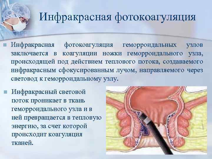 Инфракрасная фотокоагуляция n Инфракрасная фотокоагуляция геморроидальных узлов заключается в коагуляции ножки геморроидального узла, происходящей