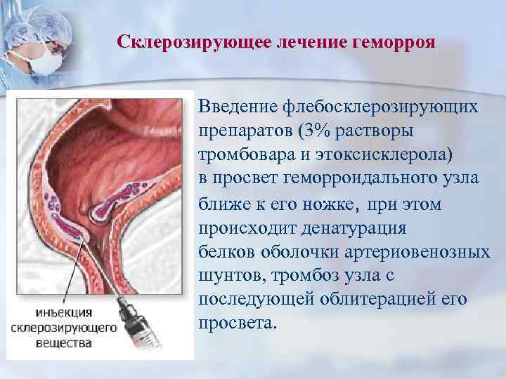 Склерозирующее лечение геморроя Введение флебосклерозирующих препаратов (3% растворы тромбовара и этоксисклерола) в просвет геморроидального