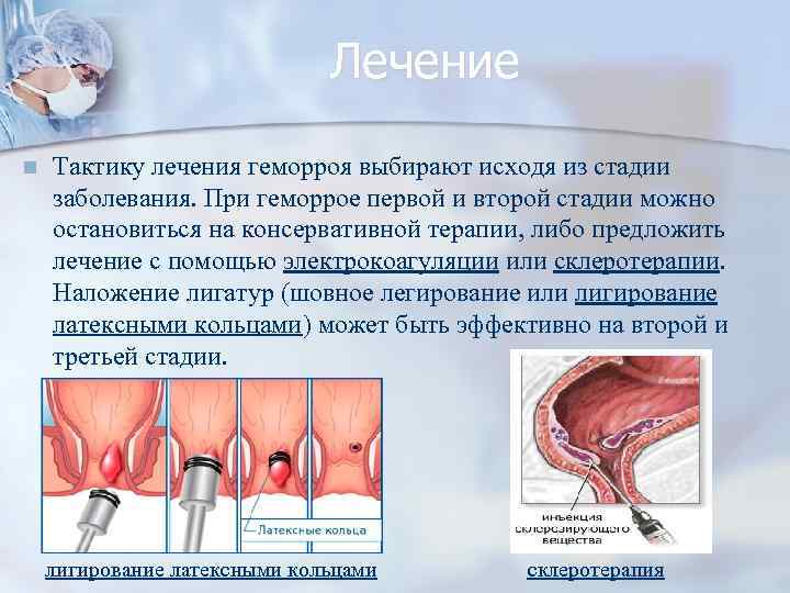 Стадии геморроя схема