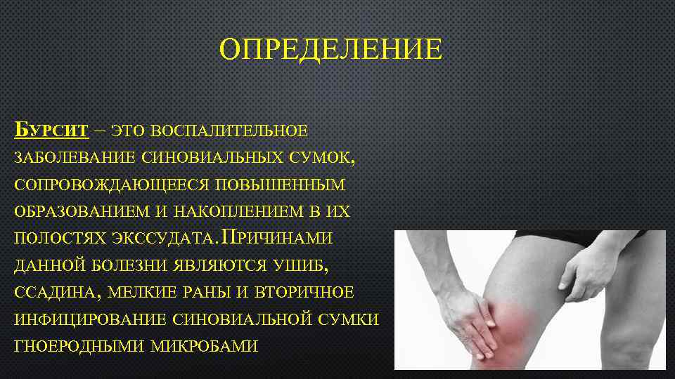 ОПРЕДЕЛЕНИЕ БУРСИТ – ЭТО ВОСПАЛИТЕЛЬНОЕ ЗАБОЛЕВАНИЕ СИНОВИАЛЬНЫХ СУМОК, СОПРОВОЖДАЮЩЕЕСЯ ПОВЫШЕННЫМ ОБРАЗОВАНИЕМ И НАКОПЛЕНИЕМ В