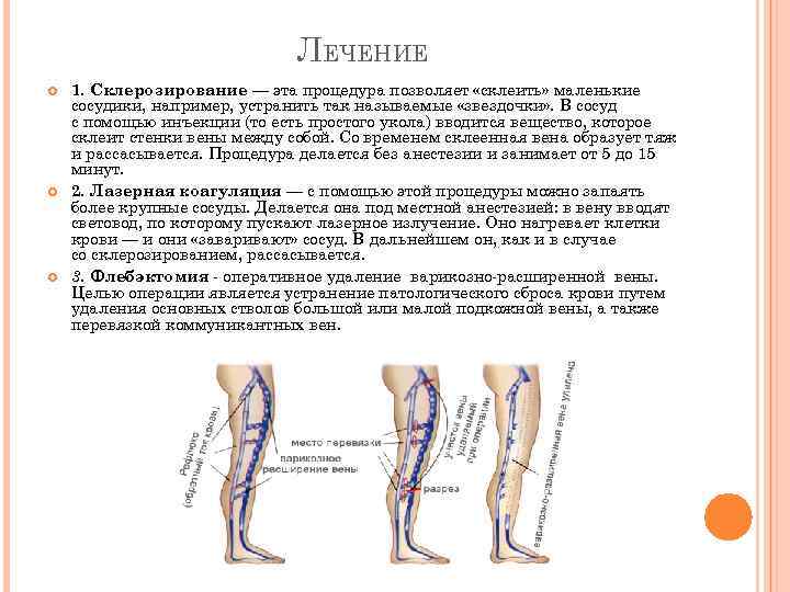 Варикоз лечение препараты схема лечения