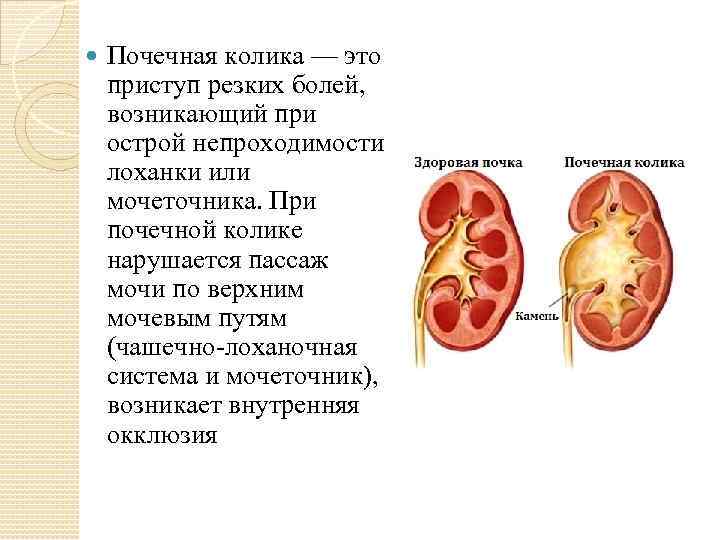  Почечная колика — это приступ резких болей, возникающий при острой непроходимости лоханки или