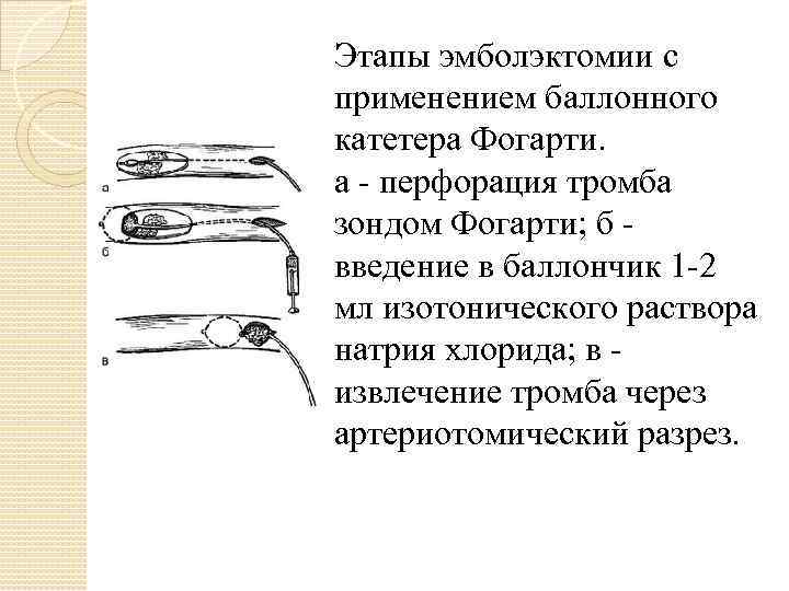 Этапы эмболэктомии с применением баллонного катетера Фогарти. а - перфорация тромба зондом Фогарти; б