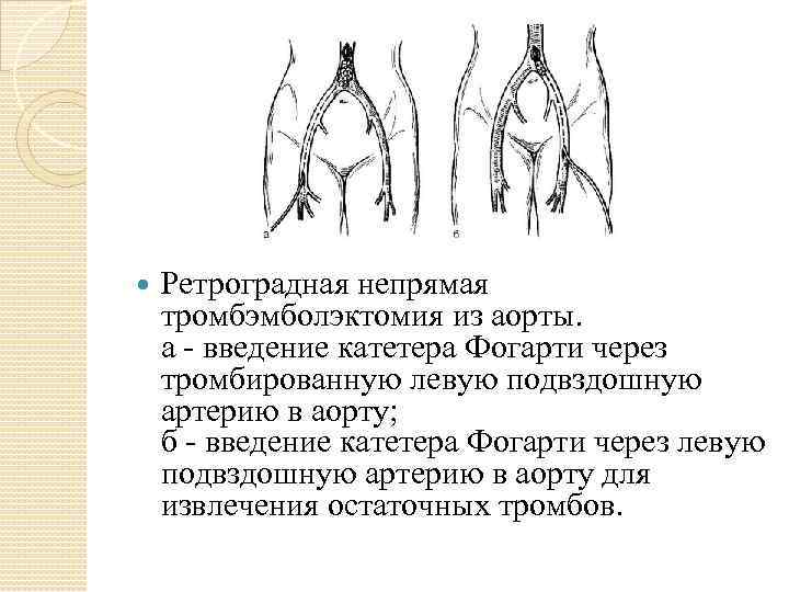  Ретроградная непрямая тромбэмболэктомия из аорты. а - введение катетера Фогарти через тромбированную левую