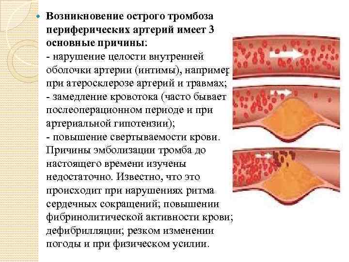  Возникновение острого тромбоза периферических артерий имеет 3 основные причины: - нарушение целости внутренней