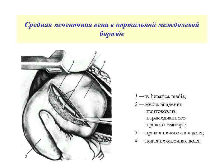 Средняя печеночная вена в портальной междолевой борозде 1 — v. hepatica media; 2 —