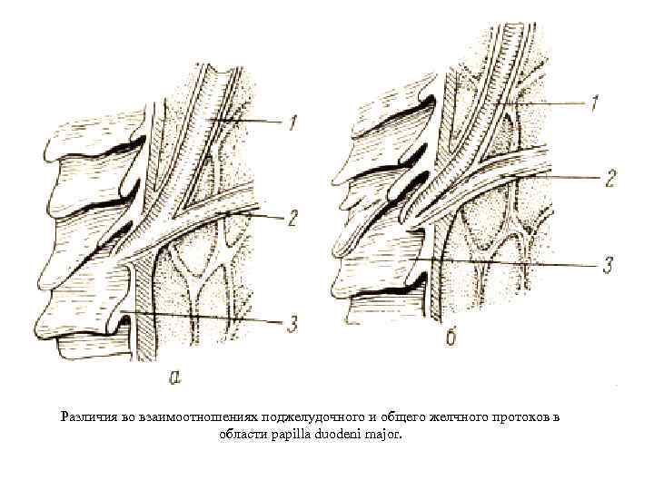 Различия во взаимоотношениях поджелудочного и общего желчного протоков в области papilla duodeni major. 