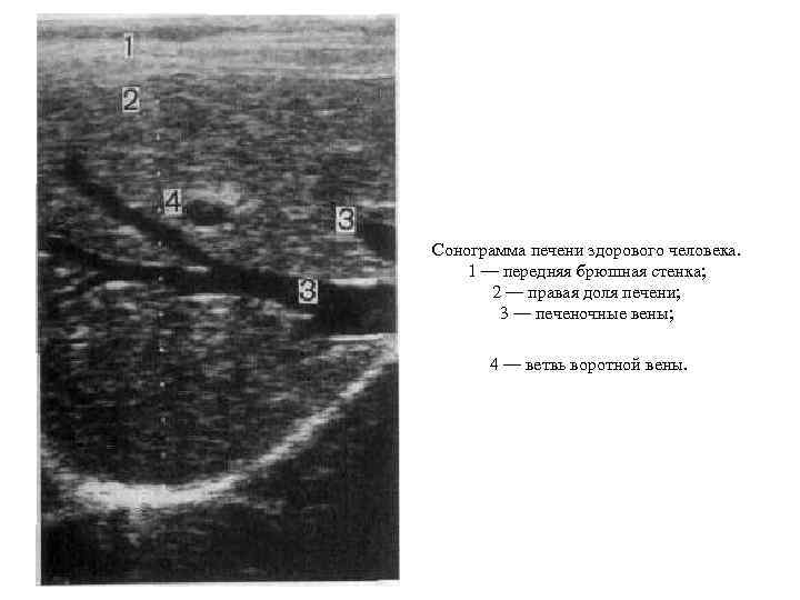 Сонограмма печени здорового человека. 1 — передняя брюшная стенка; 2 — правая доля печени;