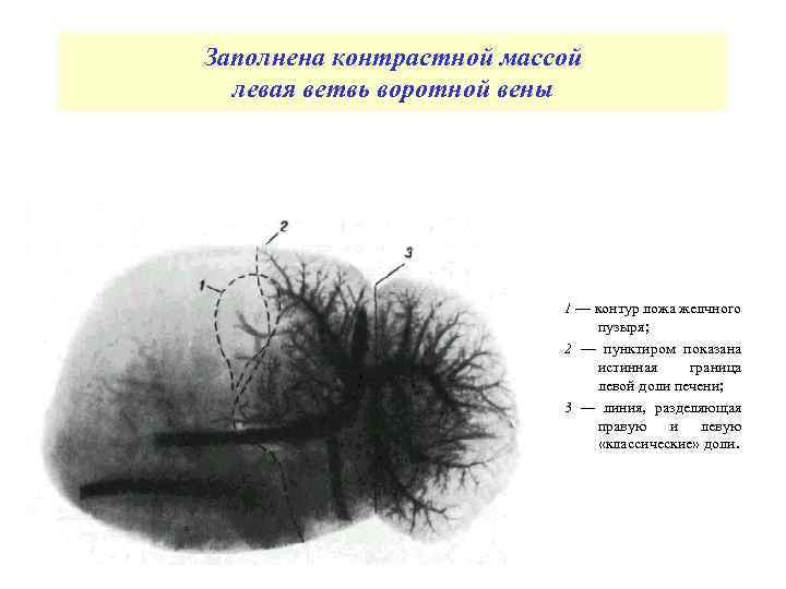 Заполнена контрастной массой левая ветвь воротной вены 1 — контур ложа желчного пузыря; 2