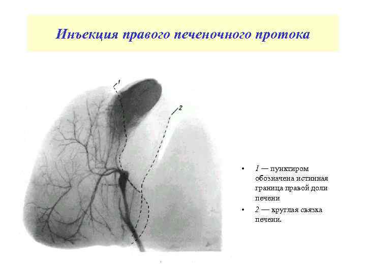 Инъекция правого печеночного протока • • 1 — пунктиром обозначена истинная граница правой доли
