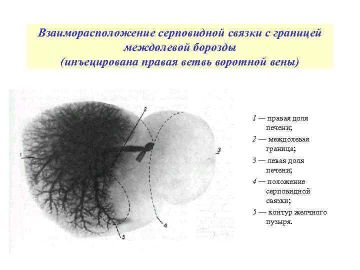 Взаиморасположение серповидной связки с границей междолевой борозды (инъецирована правая ветвь воротной вены) 1 —