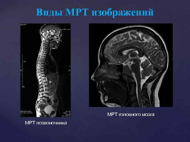 Виды МРТ изображений МРТ головного мозга МРТ позвоночника 