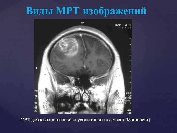 Виды МРТ изображений МРТ доброкачественной опухоли головного мозга (Магневист) 