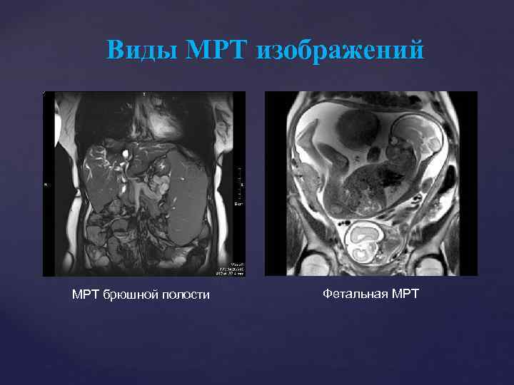 Виды МРТ изображений МРТ брюшной полости Фетальная МРТ 
