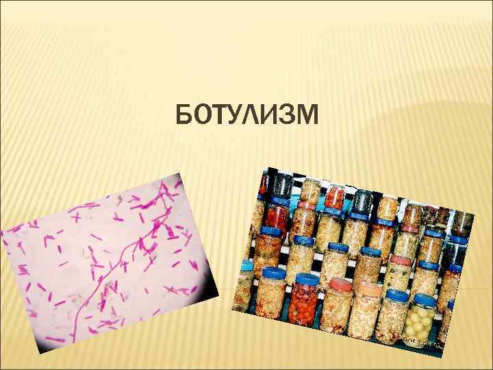 БОТУЛИЗМ 
