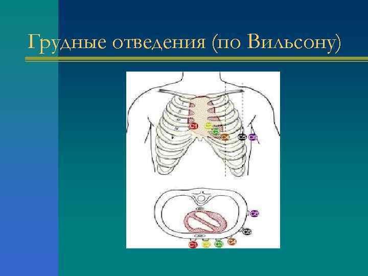 Грудные отведения (по Вильсону) 