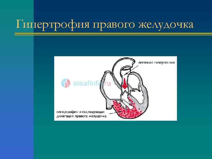 Гипертрофия правого желудочка 
