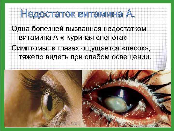 Недостаток витамина А. Одна болезней вызванная недостатком витамина А « Куриная слепота» Симптомы: в