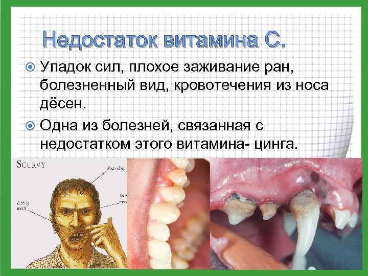 Недостаток витамина С. Упадок сил, плохое заживание ран, болезненный вид, кровотечения из носа дёсен.