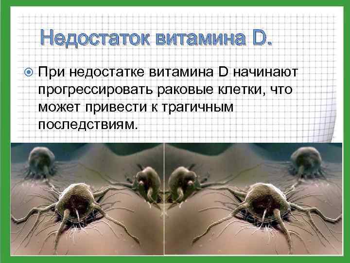 Недостаток витамина D. При недостатке витамина D начинают прогрессировать раковые клетки, что может привести